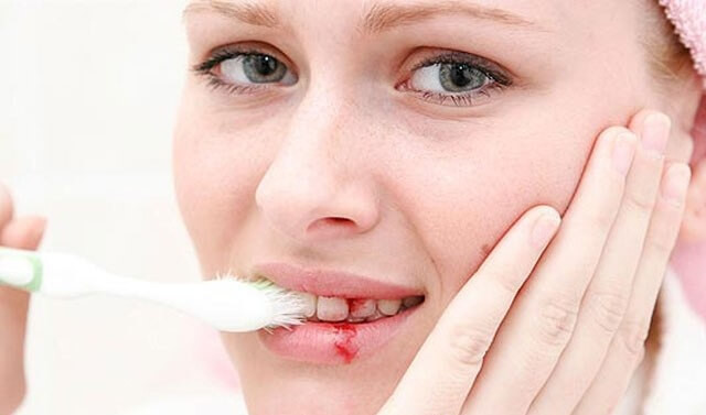 chảy máu chân răng, dấu hiệu bệnh từ chảy máu chân răng, cảnh báo bệnh khi bị chảy máu chân răng