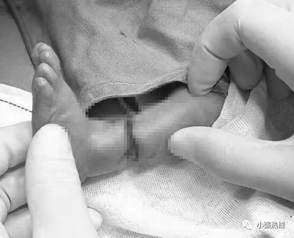 biến chứng dải sợi ối, bé sơ sinh suýt đứt chân ở trong bụng mẹ
