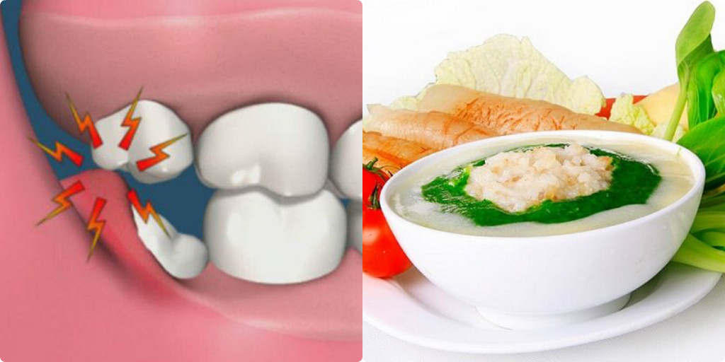 dinh dưỡng cho người mọc răng khôn, mọc răng khôn nên và không nên ăn gì