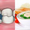 dinh dưỡng cho người mọc răng khôn, mọc răng khôn nên và không nên ăn gì