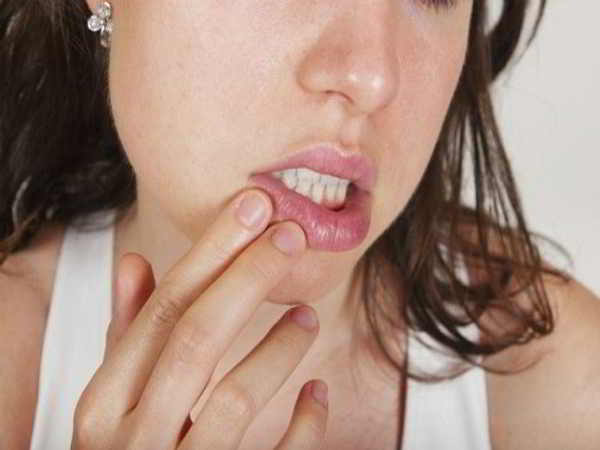 Sùi mào gà ở miệng - Nguyên nhân, biểu hiện và cách điều trị