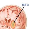 Tìm hiểu nguyên nhân và dấu hiệu của bệnh u não