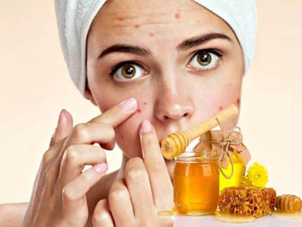 Trị mụn bằng mật ong