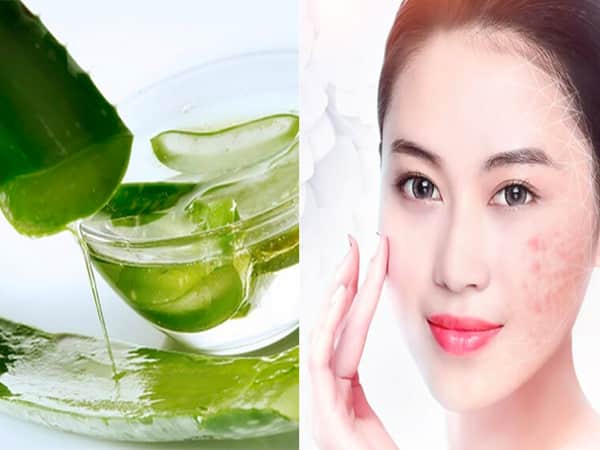 Tri mụn bằng nha đam