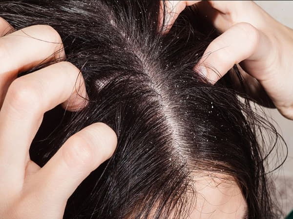 Nguyên nhân gây gàu và ngứa da đầu