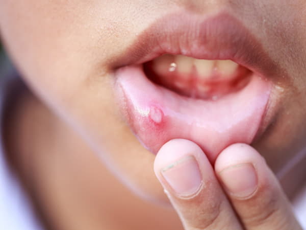 Tìm hiểu về nhiệt miệng
