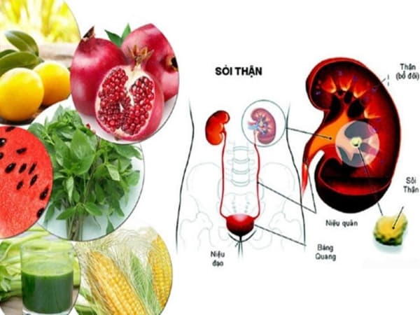 Tổng quan về bệnh sỏi thận và vai trò của chế độ ăn