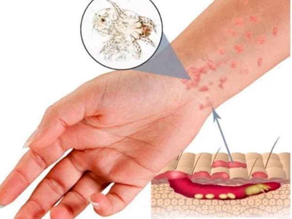 Cách trị bệnh ghẻ bằng sử dụng thuốc chống ký sinh trùng