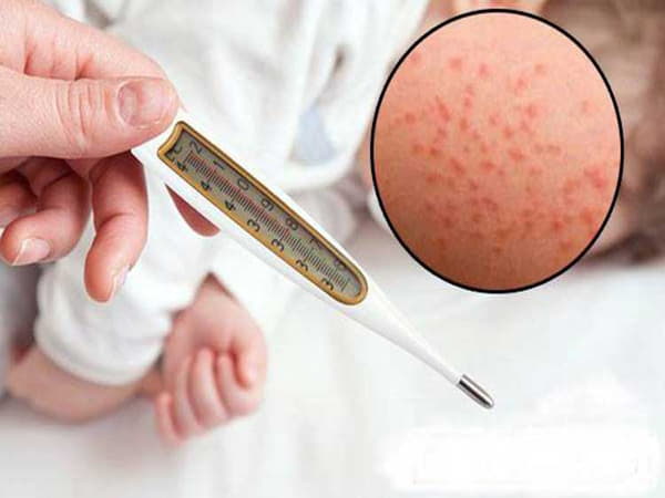 Cách trị bệnh sởi tại nhà an toàn và hiệu quả