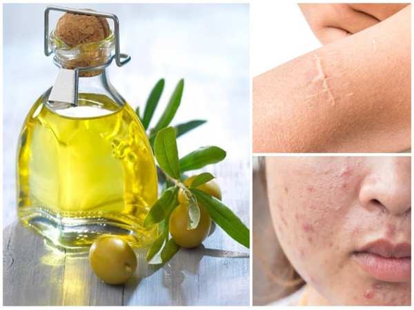 Hỗ trợ điều trị mụn trứng cá, viêm nang lông