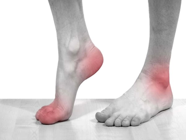 Tìm hiểu về nguyên nhân và triệu trứng bệnh Gout