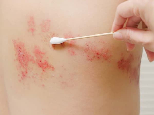 Tìm hiểu về bệnh giời leo