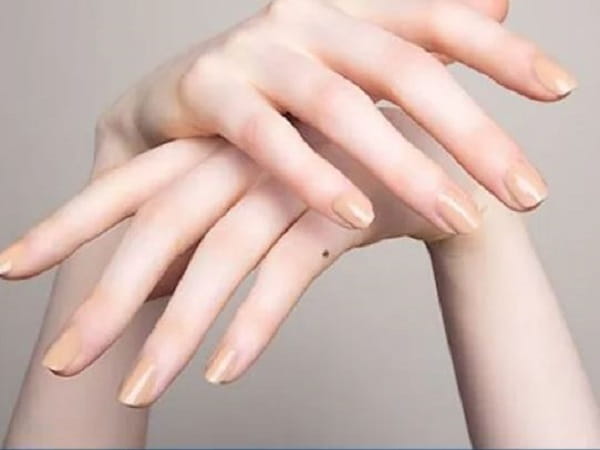 Mụn ruồi ở ngón tay út phải nữ